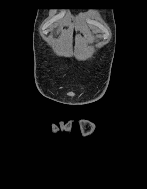 Adrenal myelolipoma - bilateral (Radiopaedia 74805-85810 Coronal C+ portal venous phase 252).jpg
