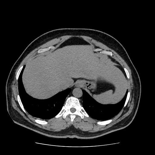 Adrenal myelolipoma and beaver tail liver (Radiopaedia 86201-102193 Axial non-contrast 64).jpg