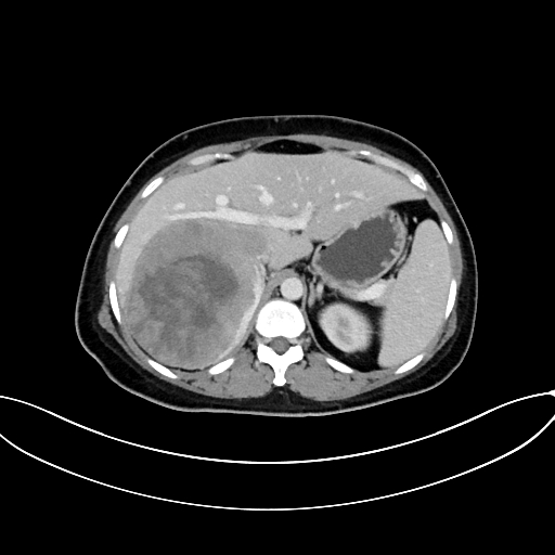File:Adrenocortical carcinoma (Radiopaedia 87281-103569 Axial C+ portal venous phase 25).jpg