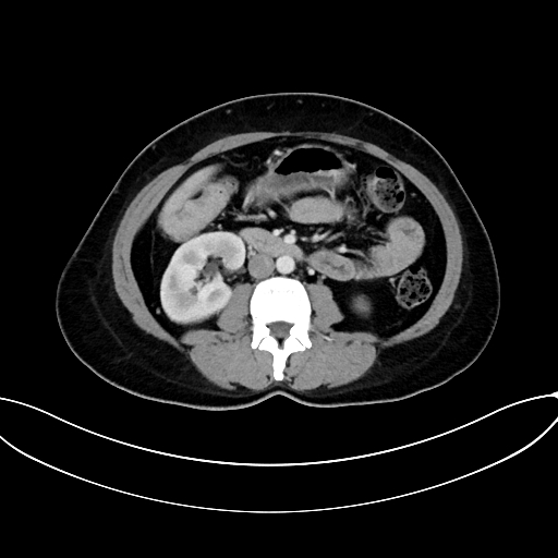 Adrenocortical carcinoma (Radiopaedia 87281-103569 Axial C+ portal venous phase 44).jpg