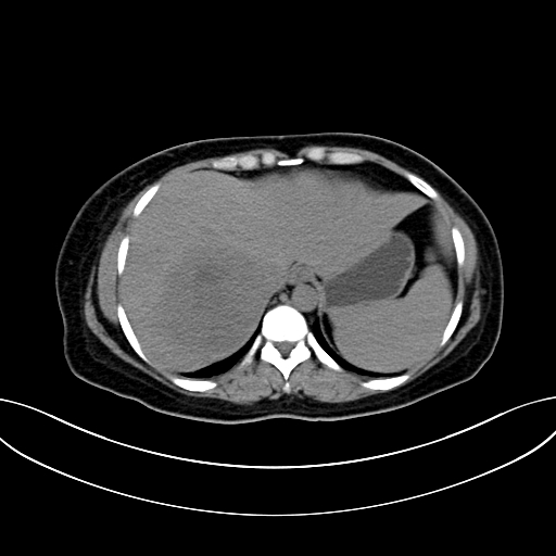 Adrenocortical carcinoma (Radiopaedia 87281-103569 Axial non-contrast 16).jpg