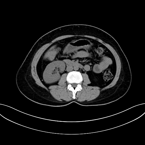 Adrenocortical carcinoma (Radiopaedia 87281-103569 Axial non-contrast 44).jpg