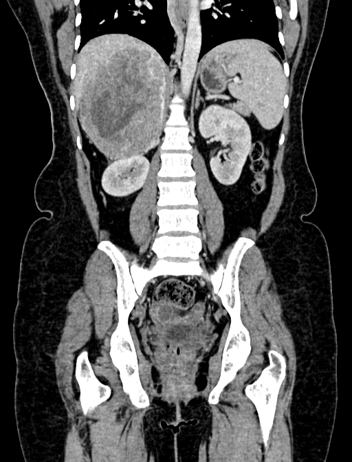 Adrenocortical carcinoma (Radiopaedia 87281-103569 Coronal C+ portal venous phase 79).jpg