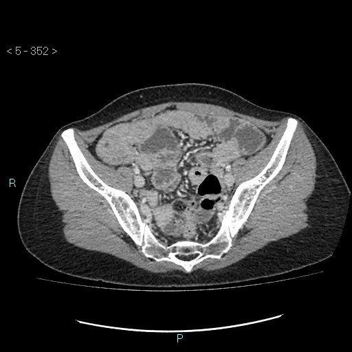 Adult transient intestinal intussusception (Radiopaedia 34853-36310 Axial C+ portal venous phase 88).jpg