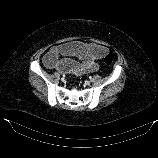Afferent loop syndrome - secondary to incarcerated trocar site hernia (Radiopaedia 82959-97305 Axial C+ portal venous phase 179).jpg