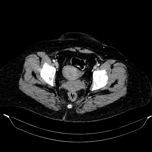 Afferent loop syndrome - secondary to incarcerated trocar site hernia (Radiopaedia 82959-97305 Axial C+ portal venous phase 216).jpg