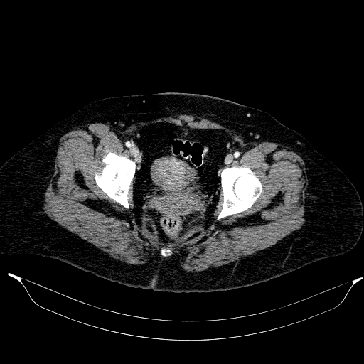 File:Afferent loop syndrome - secondary to incarcerated trocar site hernia (Radiopaedia 82959-97305 Axial C+ portal venous phase 218).jpg