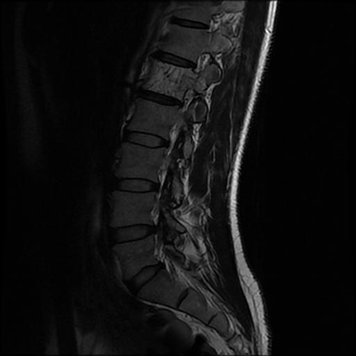 File:Aggressive vertebral hemangioma with pathological fracture (Radiopaedia 69528-79411 Sagittal T2 3).jpg