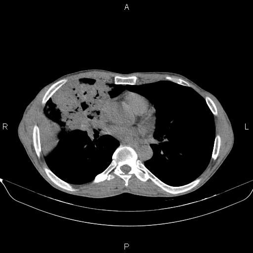 Air bronchogram in pneumonia (Radiopaedia 85719-101512 Axial non-contrast 37).jpg