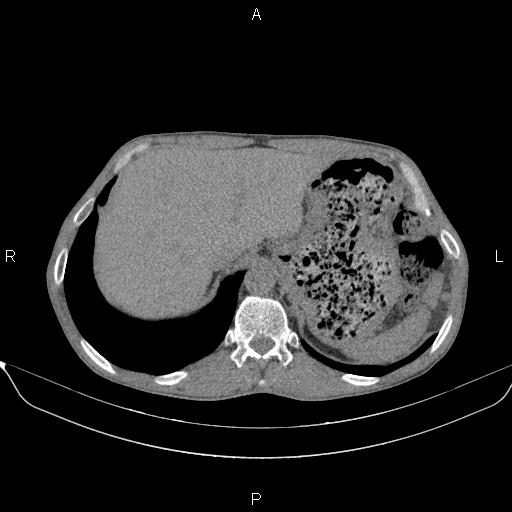 Air bronchogram in pneumonia (Radiopaedia 85719-101512 Axial non-contrast 63).jpg