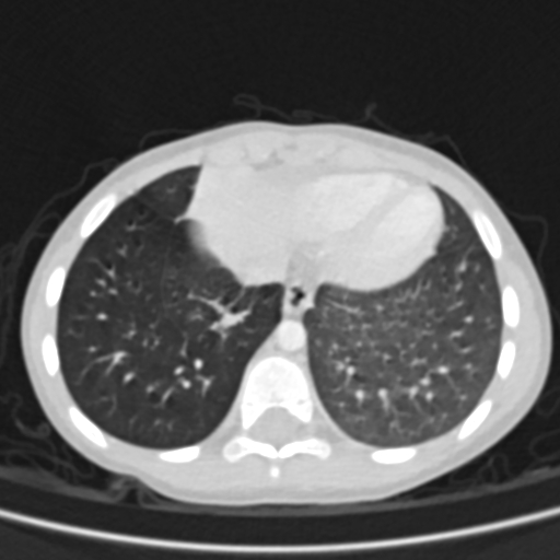 Airway foreign body (Radiopaedia 72128-82638 Axial lung window 72).jpg