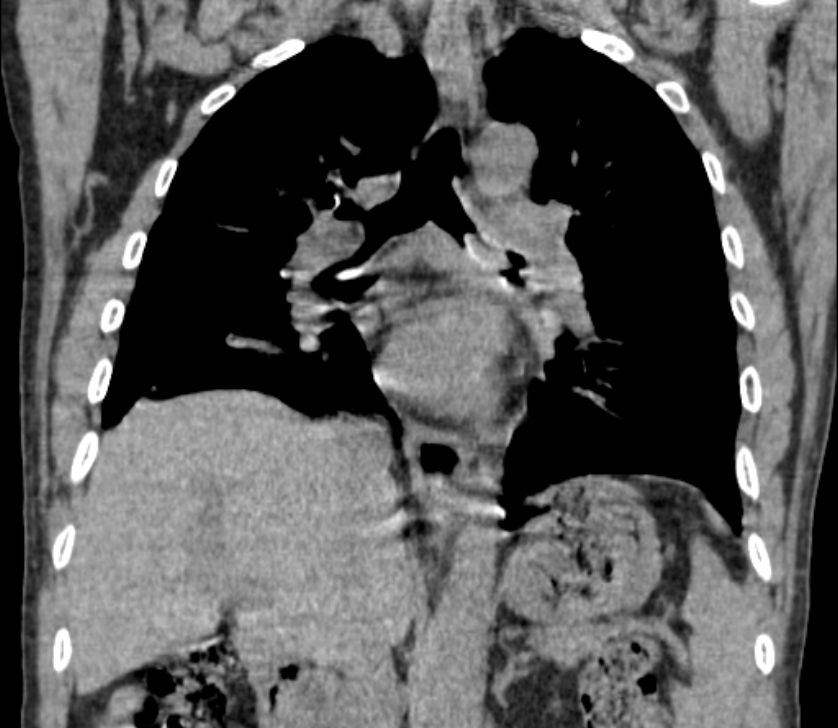 Airway foreign body in adult (Radiopaedia 85907-101779 Coronal liver window 150).jpg