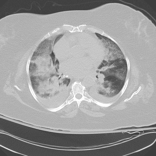 All trans retinoic acid (ATRA) syndrome (Radiopaedia 38212-40229 Axial lung window 30).jpg