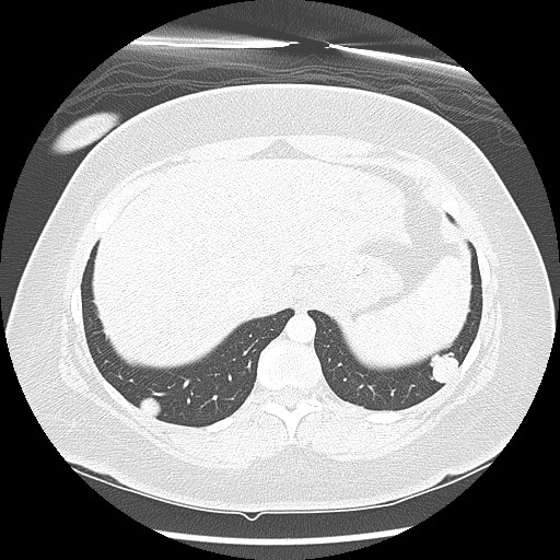 Alveolar soft part sarcoma - right leg (Radiopaedia 59432-67091 Axial lung window 98).jpg