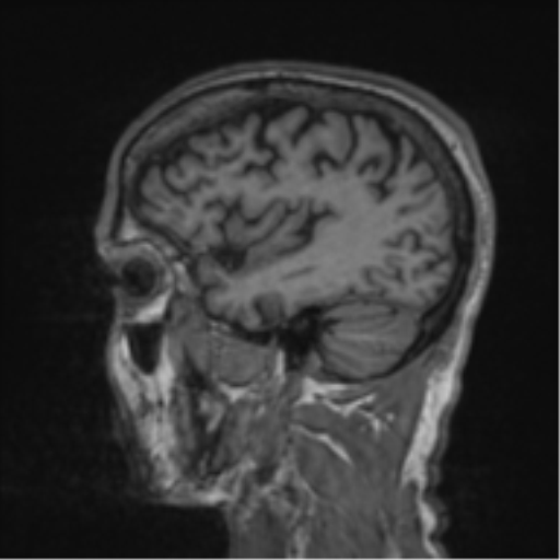 File:Alzheimer's disease- with apraxia (Radiopaedia 54763-61011 Sagittal T1 54).png