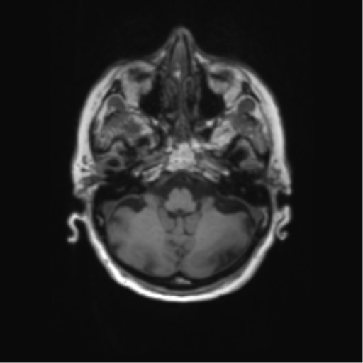 File:Alzheimer's disease (Radiopaedia 42658-45802 Axial T1 121).png