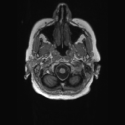 File:Alzheimer's disease (Radiopaedia 42658-45802 Axial T1 139).png