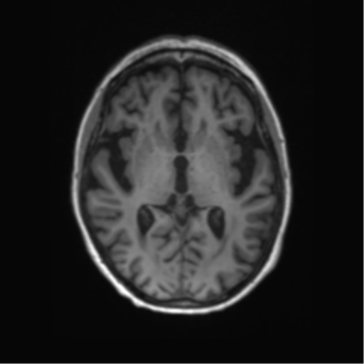 Alzheimer's disease (Radiopaedia 42658-45802 Axial T1 82).png