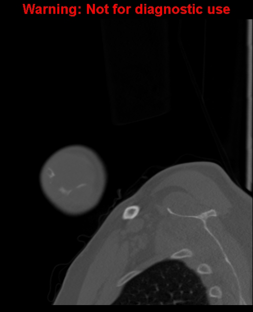 Ameloblastoma (Radiopaedia 33126-34164 Sagittal bone window 8).jpg