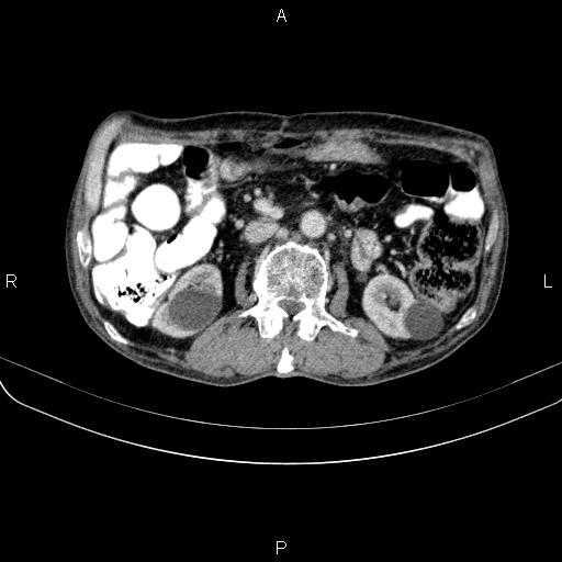 Ampullary adenocarcinoma (Radiopaedia 86093-102033 B 69).jpg