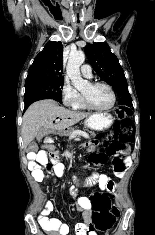 Ampullary adenocarcinoma (Radiopaedia 86093-102033 D 20).jpg
