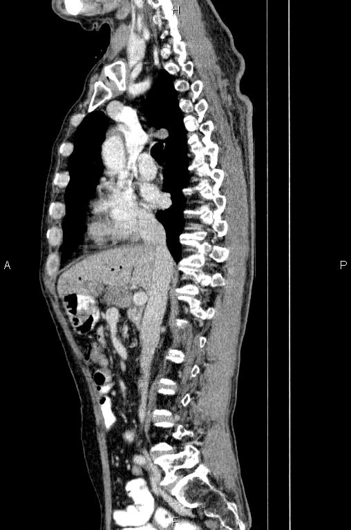 Ampullary adenocarcinoma (Radiopaedia 86093-102033 E 39).jpg