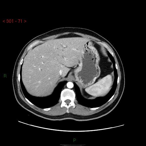 File:Ampullary carcinoma (Radiopaedia 56396-63056 B 17).jpg