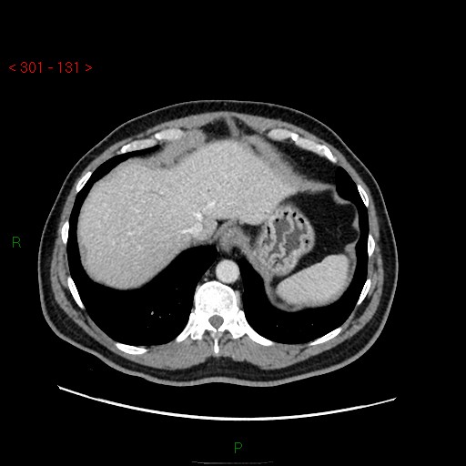 File:Ampullary carcinoma (Radiopaedia 56396-63056 C 15).jpg
