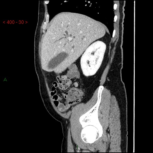 File:Ampullary carcinoma (Radiopaedia 56396-63056 D 29).jpg