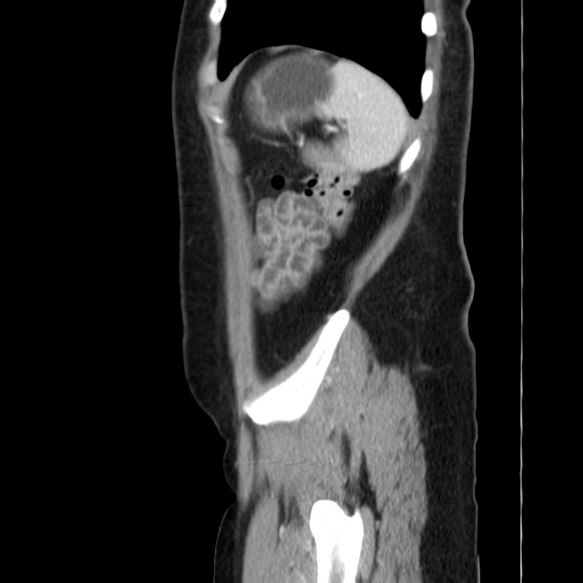 Ampullary tumor (Radiopaedia 22787-22816 D 48).jpg
