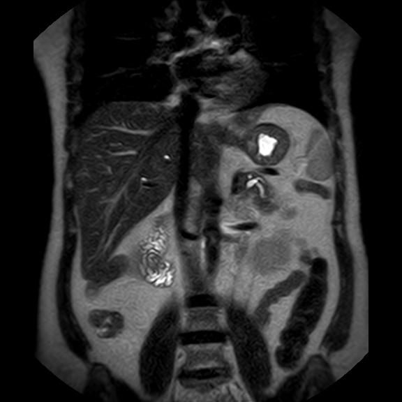 File:Ampullary tumor (Radiopaedia 27294-27479 Coronal T2 14).jpg