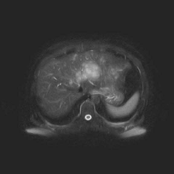 File:Ampullary tumor (Radiopaedia 27294-27479 T2 SPAIR 17).jpg