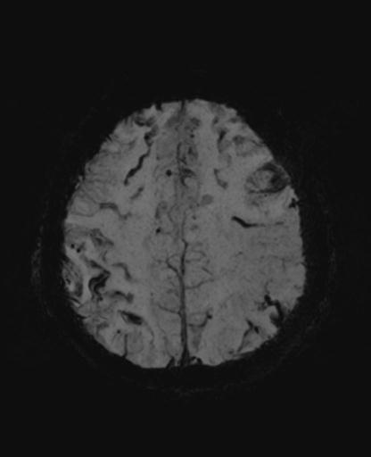 File:Amyloid angiopathy with inflammation (Radiopaedia 30360-31002 Axial SWI MIP 48).jpg
