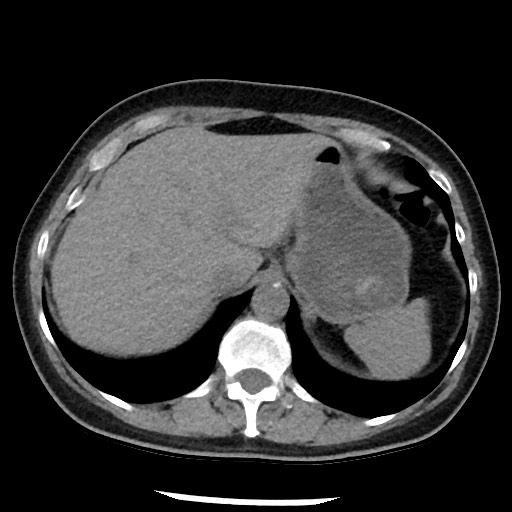Amyloidosis - bronchial and diffuse nodular pulmonary involvement (Radiopaedia 60156-67744 Axial non-contrast 52).jpg
