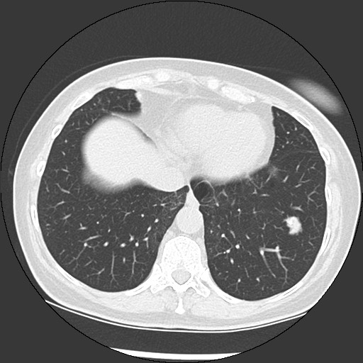 Amyloidosis - bronchial and diffuse nodular pulmonary involvement (Radiopaedia 60156-67744 B 44).jpg