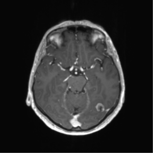 File:Anaplastic astrocytoma (Radiopaedia 86943-103160 Axial T1 C+ 12).png