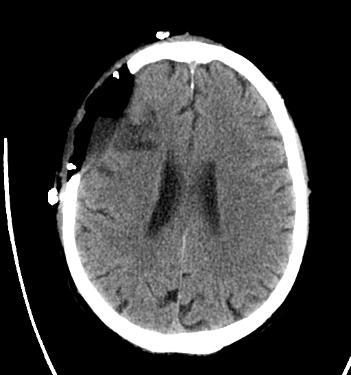 File:Anaplastic meningioma with recurrence (Radiopaedia 34452-35786 Axial non-contrast 21).png