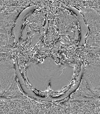 Anaplastic oligodendroglioma (Radiopaedia 83500-98599 Axial SWI - phase 11).png