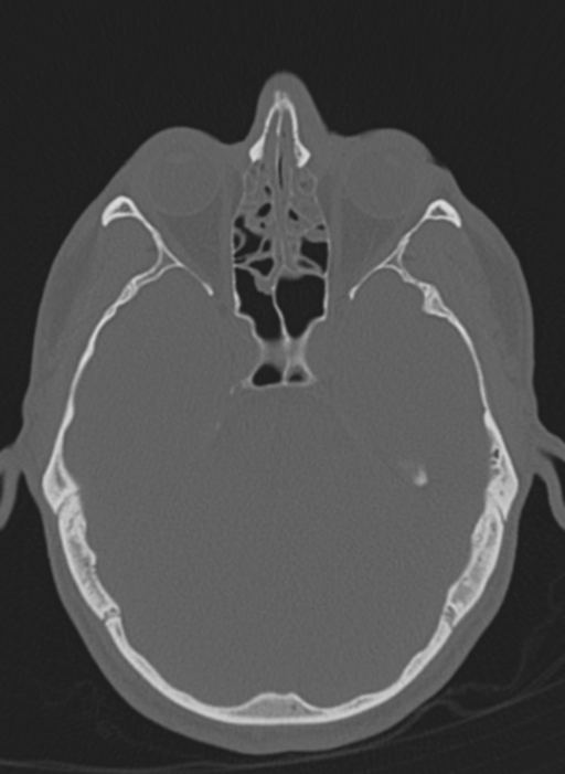 Anaplastic oligodendroglioma with skull fracture (Radiopaedia 74831-85846 Axial bone window 51).png