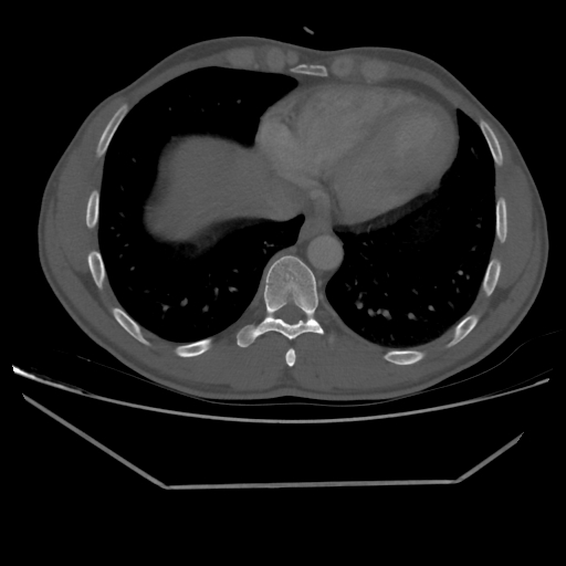 File:Aneurysmal bone cyst - rib (Radiopaedia 82167-96220 Axial bone window 191).jpg