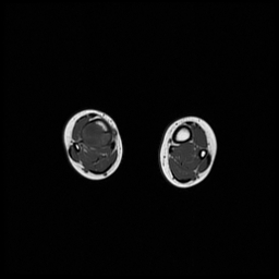 File:Aneurysmal bone cyst - tibia (Radiopaedia 22343-22367 Axial T1 10).jpg