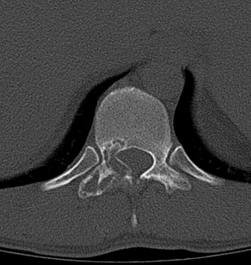 Aneurysmal bone cyst T11 (Radiopaedia 29294-29721 Axial bone window 40).jpg