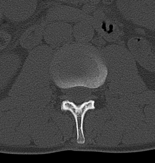 Aneurysmal bone cyst T11 (Radiopaedia 29294-29721 Axial bone window 81).jpg