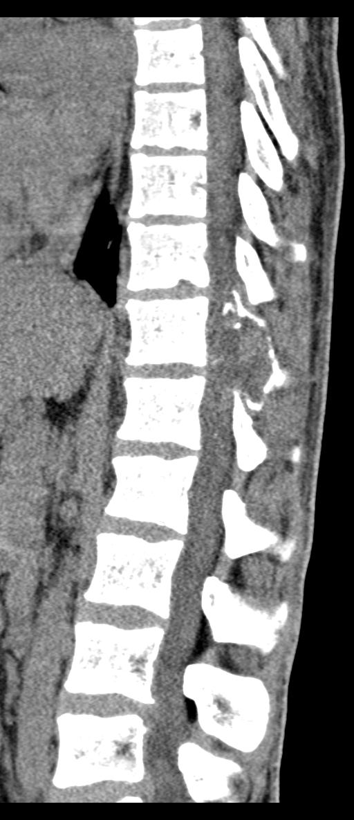 Aneurysmal bone cyst T11 (Radiopaedia 29294-29721 E 42).jpg