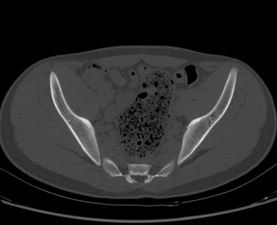 File:Aneurysmal bone cyst of ischium (Radiopaedia 25957-26094 Axial bone window 34).png