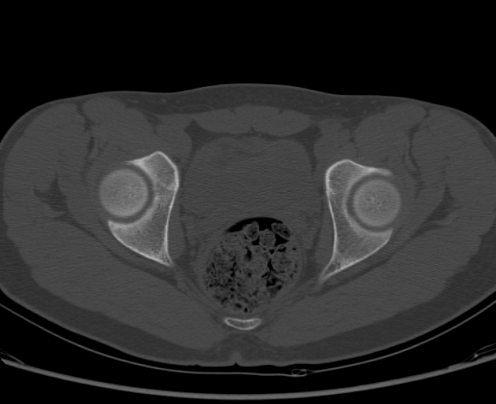 File:Aneurysmal bone cyst of ischium (Radiopaedia 25957-26094 Axial bone window 53).png