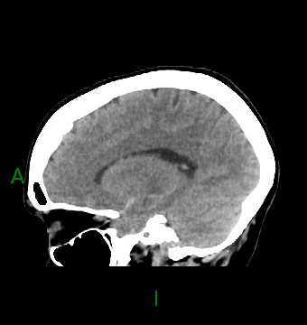 File:Aneurysmal subarachnoid hemorrhage with intra-axial extension (Radiopaedia 84371-99699 B 31).jpg