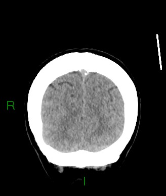 File:Aneurysmal subarachnoid hemorrhage with intra-axial extension (Radiopaedia 84371-99699 Coronal non-contrast 13).jpg