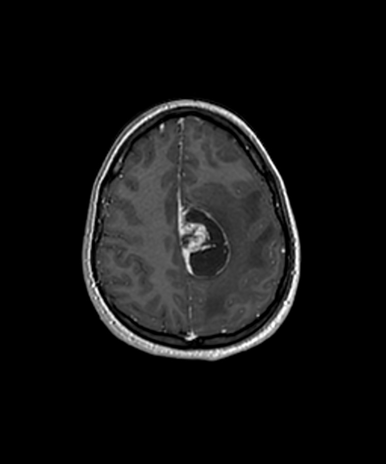 Angiomatous meningioma (Radiopaedia 79459-92577 Axial T1 C+ 3D ISO 37).jpg