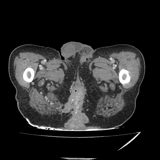 Anorectal carcinoma (Radiopaedia 44413-48064 A 64).jpg